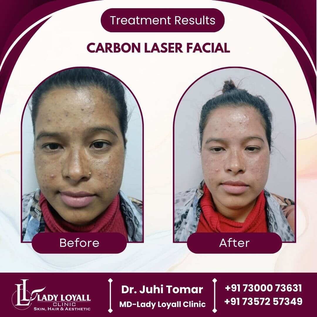 Carbon Laser Facial