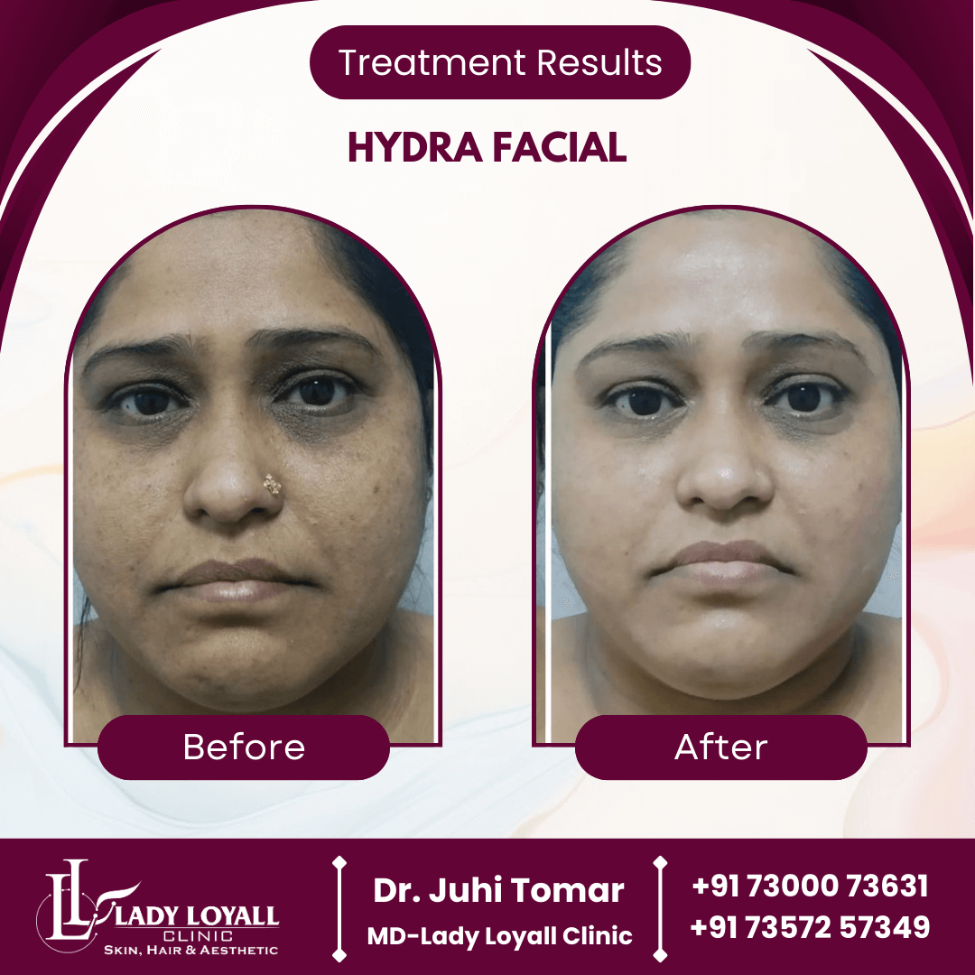 Hydra Facial