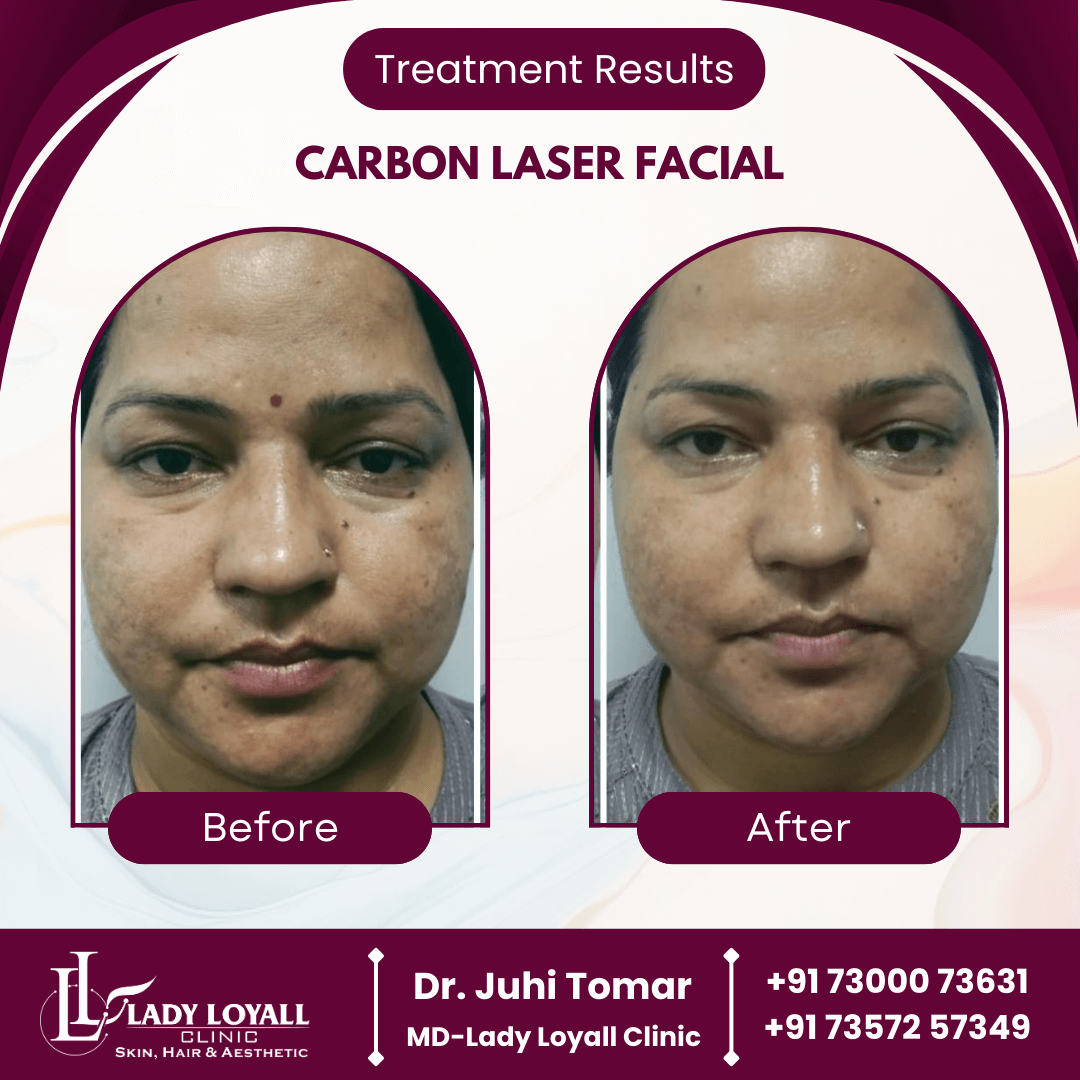 Carbon Laser Facial