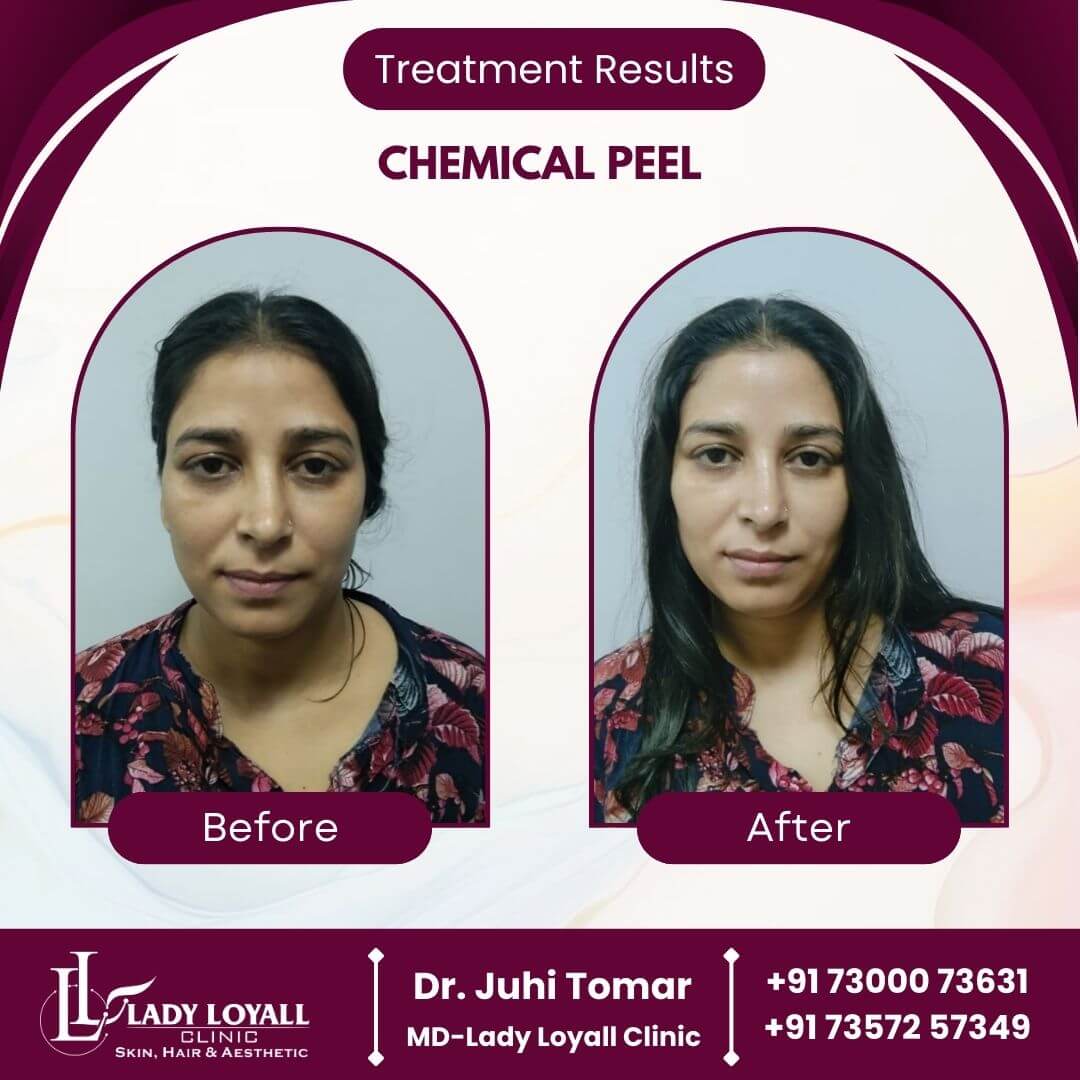 Chemical Peel