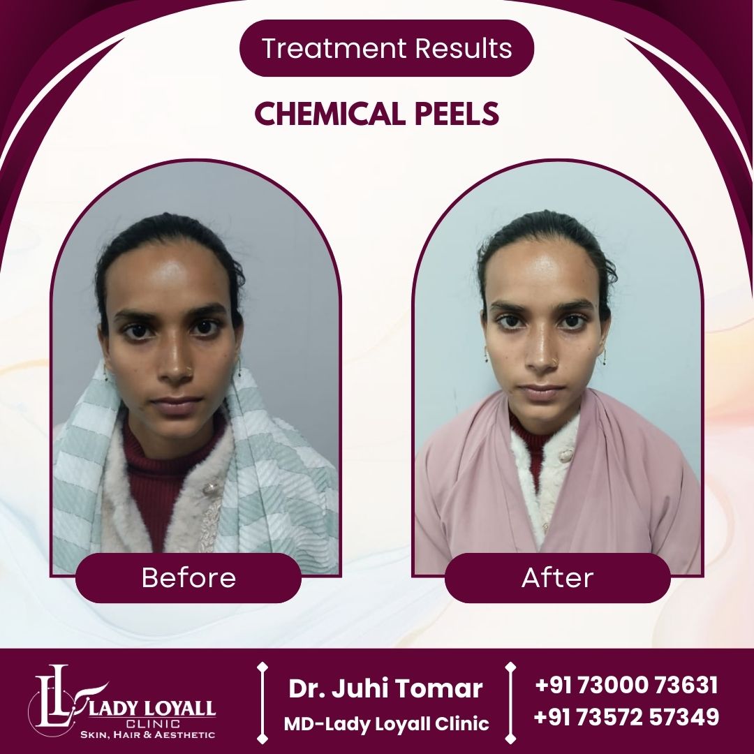Chemical Peel