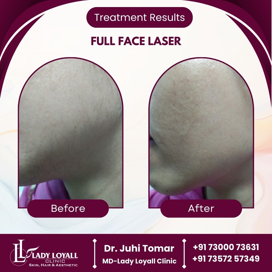 Full Face Laser