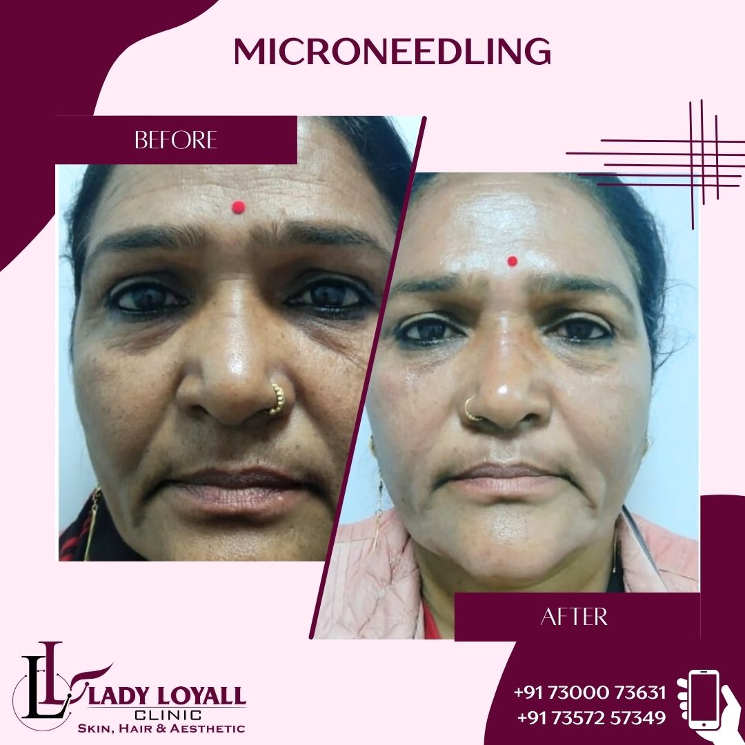 Microneedling