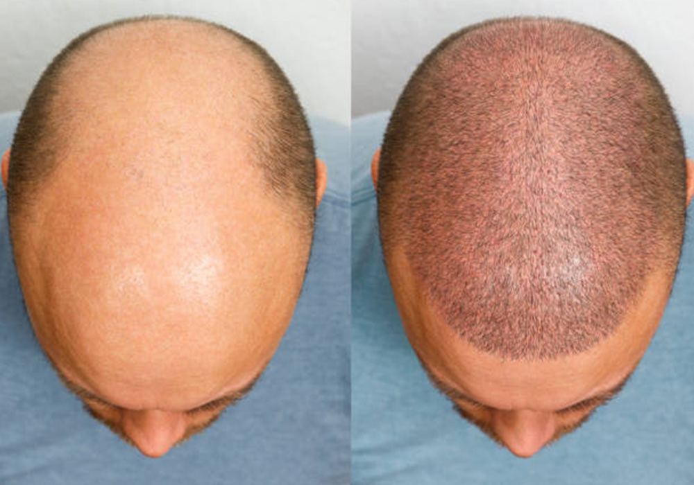 Hair Transplant